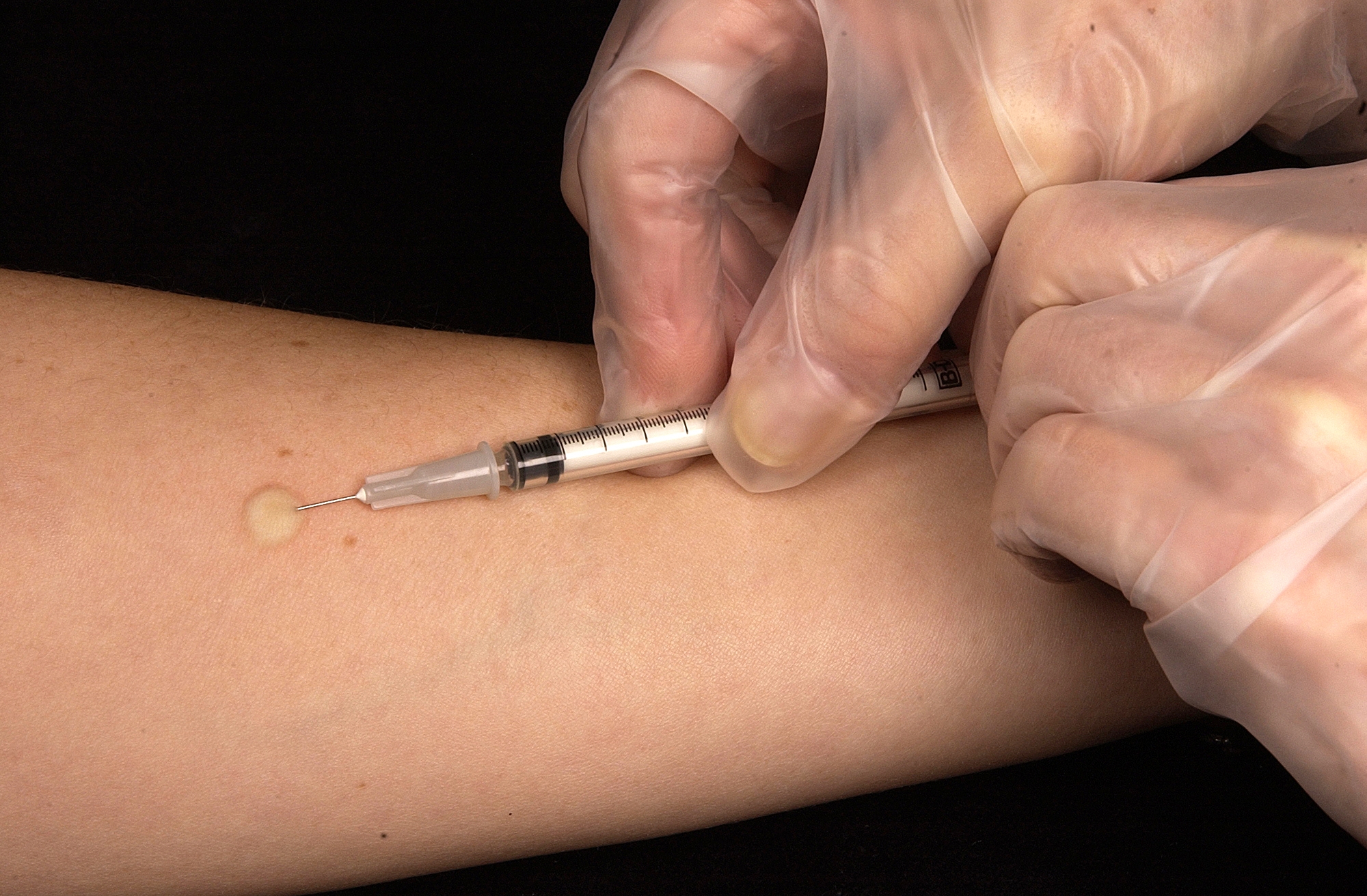 Mantoux Test Wikipedia